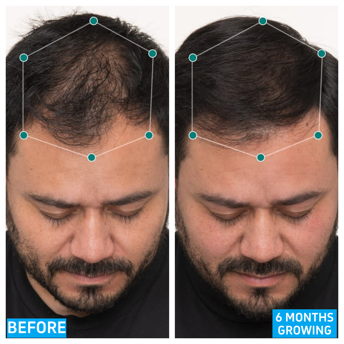 Nutrafol Men's Hair Growth Supplements, Clinically Tested for Visibly Thicker Hair and Scalp Coverage, Dermatologist Recommended - 1 Month Supply